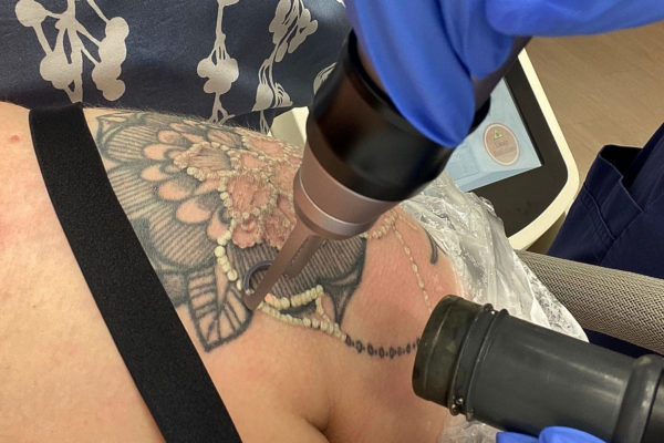 en tatuerings tas brt med laser