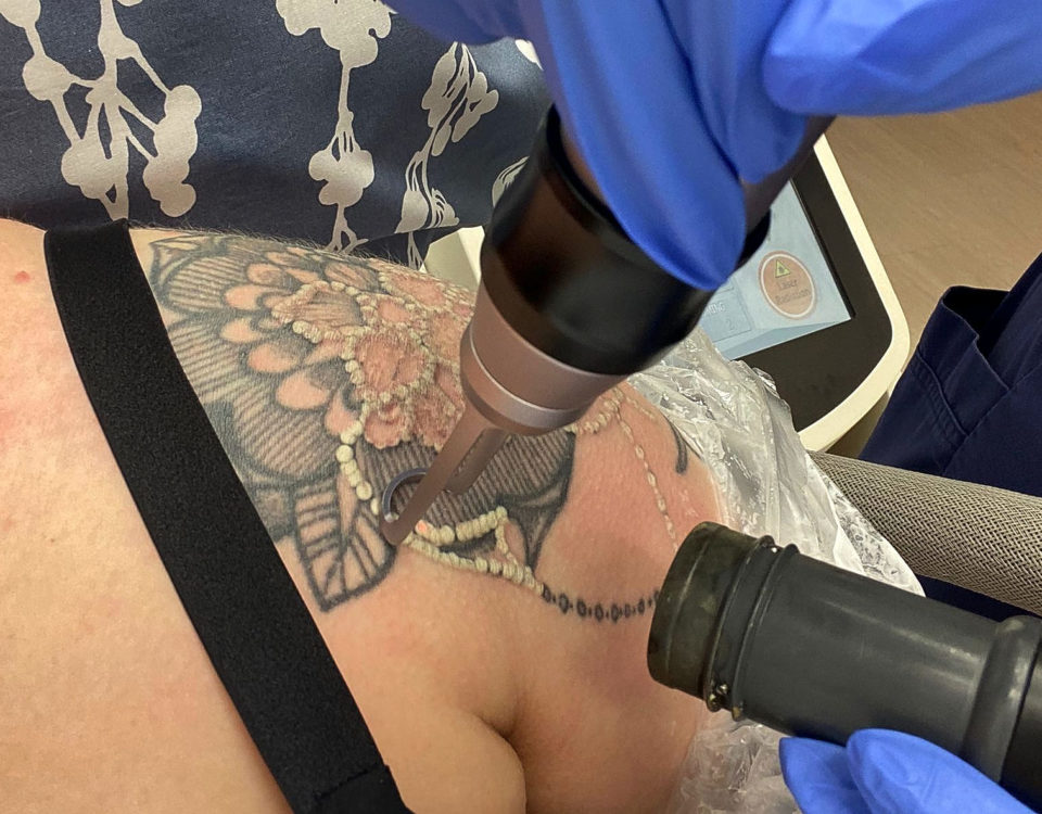en tatuerings tas brt med laser